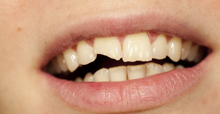 Broken Tooth