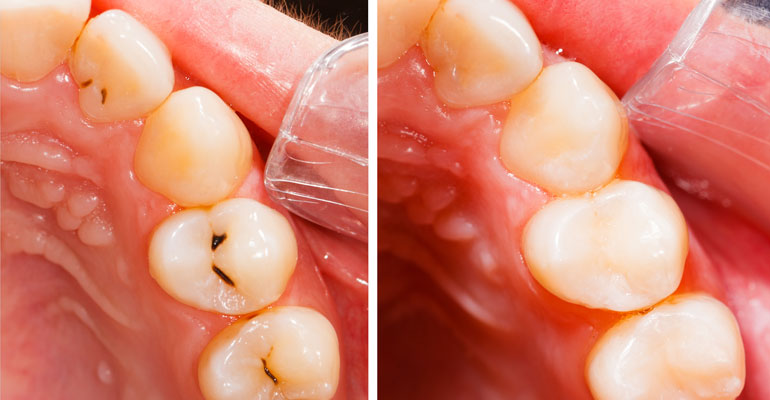 Composite Filling