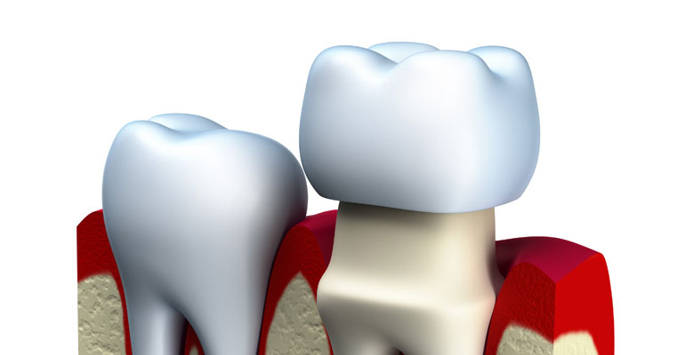 Tooth Crown