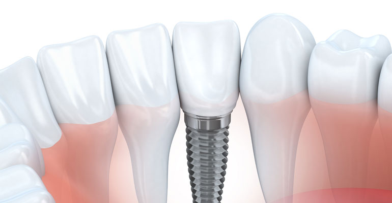 Dental Implant
