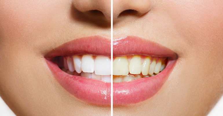 Teeth Whitening