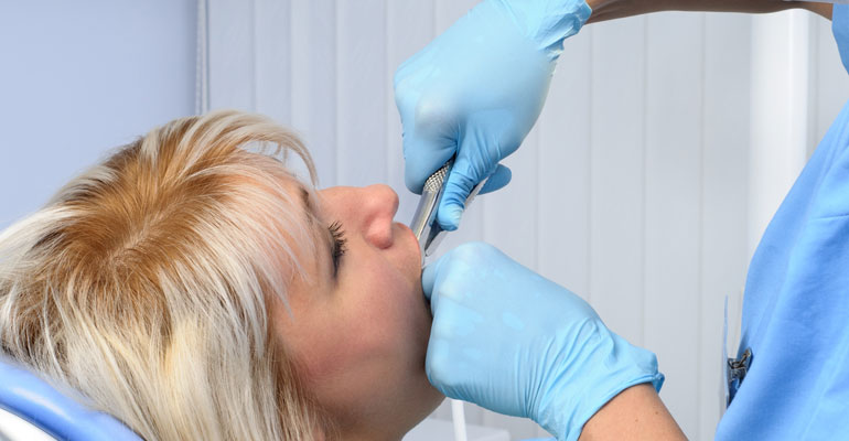 Tooth Extraction