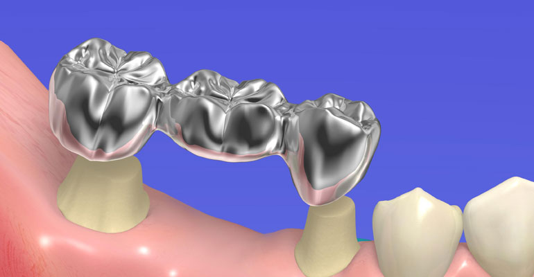 Dental Bridge